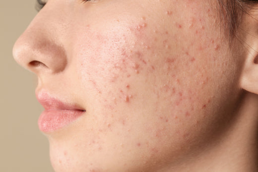 I discovered my magic healer for acne